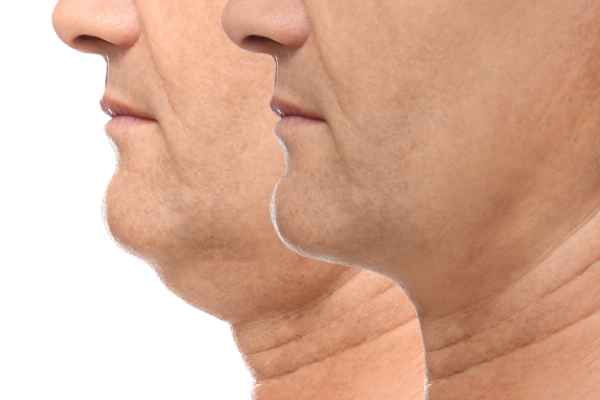 HIFU - Breakthrough in Anti - ageing 2 hifu results Calne