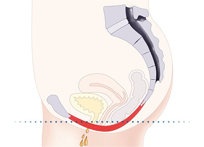 Pelvic-Floor Muscle Repair 5 Pelvic floor muscles Calne