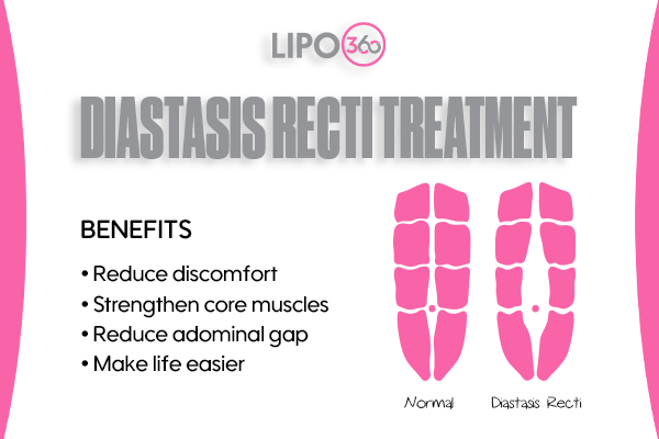 Revolutionising Muscle Repair: The Power of LIPO360 Body Sculpt Post-Injury 5 diastasis recti treatment Calne