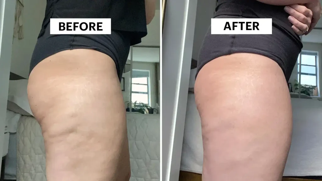 Do Toning Exercise Calne Really Tackle Cellulite?