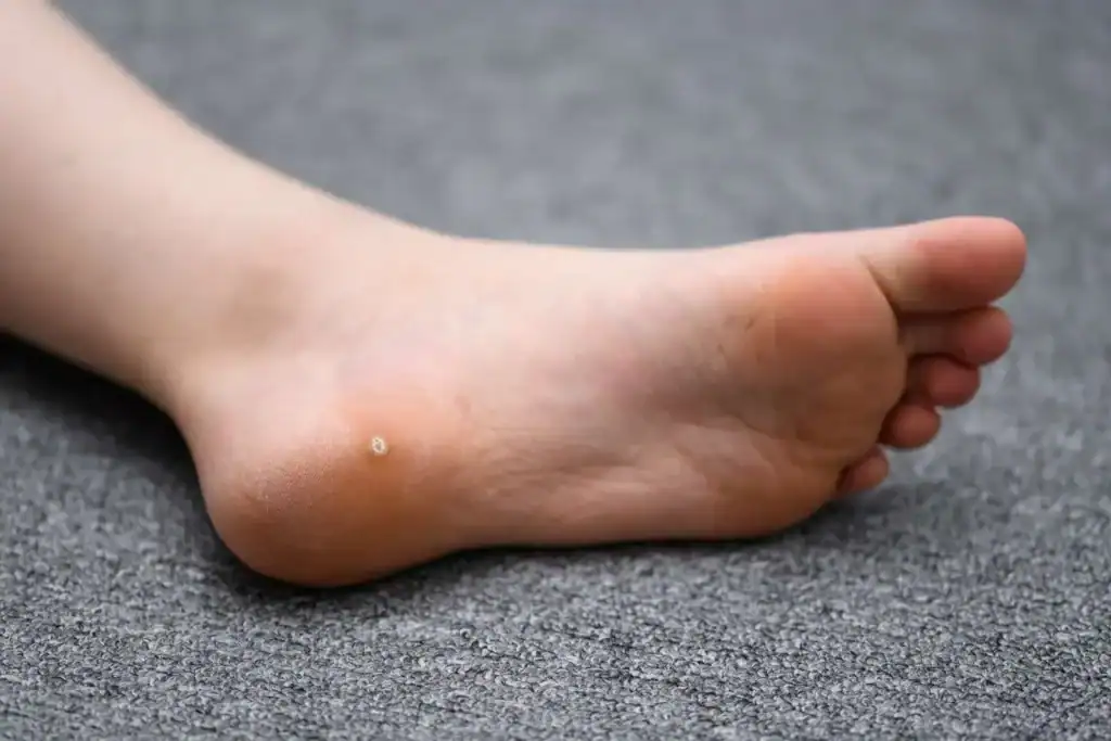 Cryotherapy For Warts And Also Verrucas 2 Image of verruca on the bottom of the foot that able to be treated with Cryotherapy Calne