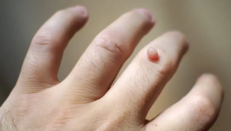 Image of blemish that Cryotherapy Calne can remove with Lipo 360.