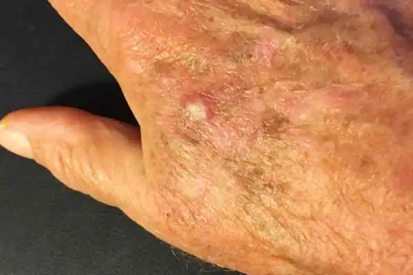 Cryopen For Actinic Keratoses 1 Image of Actinic keratoses Calne on a person hand