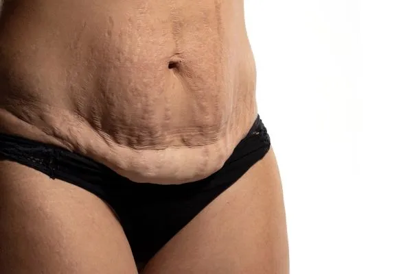 The science behind skin tightening Calne picture of a woman's sagging skin on the stomach